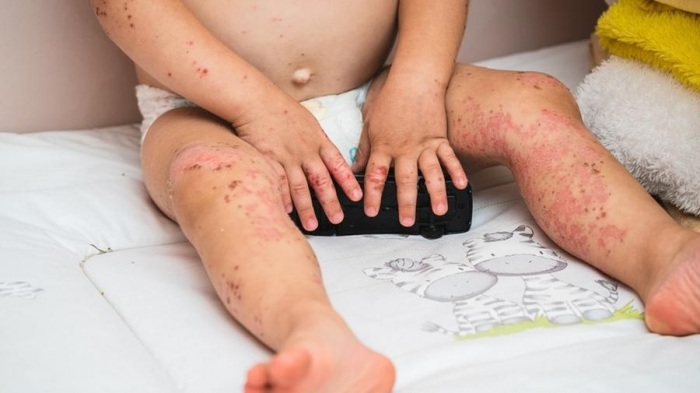 SIMDROME-MAO-PE-BOCA (1)