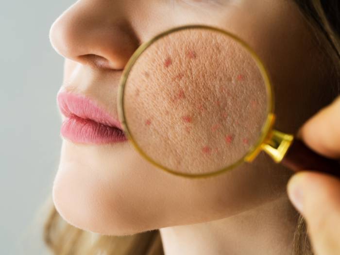 acnes-foto-getty-images (1)