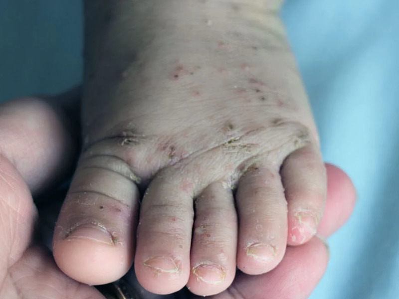 escabiose-foto-imagem-1200x900 (1)