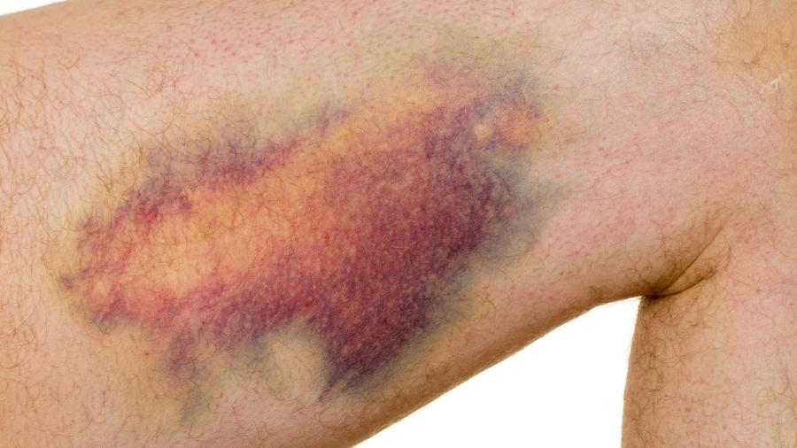 hematoma-1646924764522_v2_900x506